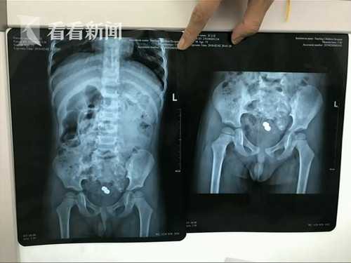 Tưởng con bị t&aacute;o b&oacute;n n&ecirc;n cứ &eacute;p con ăn rau hẹ, bố mẹ kh&ocirc;ng ngờ sự việc nghi&ecirc;m trọng hơn tưởng tượng - Ảnh 1.