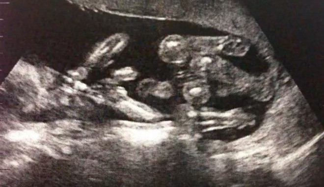 Chưa kịp vui mừng vì sắp được đón 2 con sinh đôi, người phụ nữ đau đớn khi nhận được thông báo từ bác sĩ - Ảnh 4.