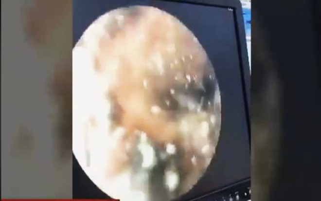 Long An: B&eacute; g&aacute;i 4 th&aacute;ng tuổi bị gi&ograve;i l&agrave;m tổ, ăn chảy m&aacute;u lỗ tai - Ảnh 2.