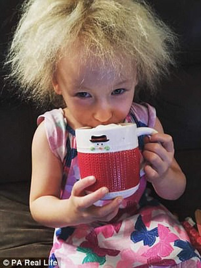 Cô bé 6 tuổi mắc hội chứng hiếm gặp khiến mái tóc dựng đứng bất thường - Ảnh 2.