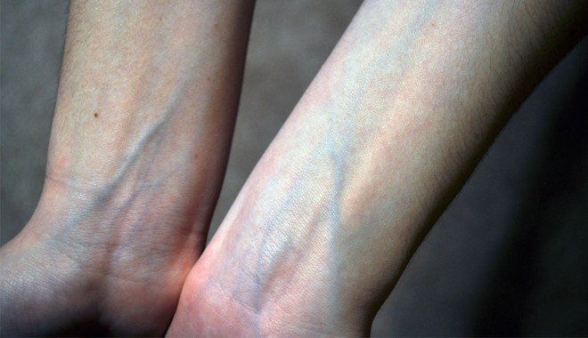 Cơ thể nổi l&ecirc;n những đường g&acirc;n xanh bất thường l&agrave; dấu hiệu sức khỏe bạn  kh&ocirc;ng n&ecirc;n bỏ qua