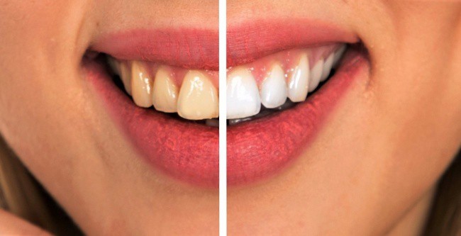 8 mẹo vặt hữu &iacute;ch gi&uacute;p bạn lu&ocirc;n n&oacute;i kh&ocirc;ng với bệnh s&acirc;u răng - Ảnh 9.
