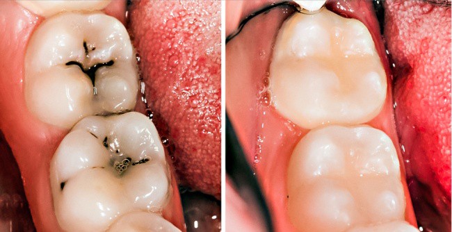 8 mẹo vặt hữu &iacute;ch gi&uacute;p bạn lu&ocirc;n n&oacute;i kh&ocirc;ng với bệnh s&acirc;u răng - Ảnh 11.