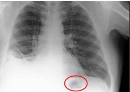 Ho dai dẳng nên đi khám, người đàn ông hoảng sợ khi bác sĩ thông báo có khối u ở phổi nhưng đến khi lấy ra mới vỡ lẽ - Ảnh 2.