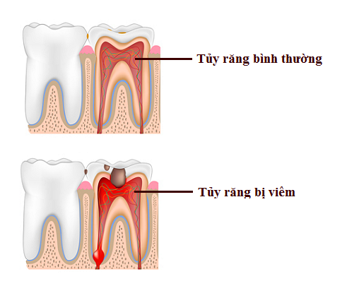 Bọc răng sứ không đảm bảo chất lượng, bạn phải đối mặt với những nguy cơ không ngờ - Ảnh 3.