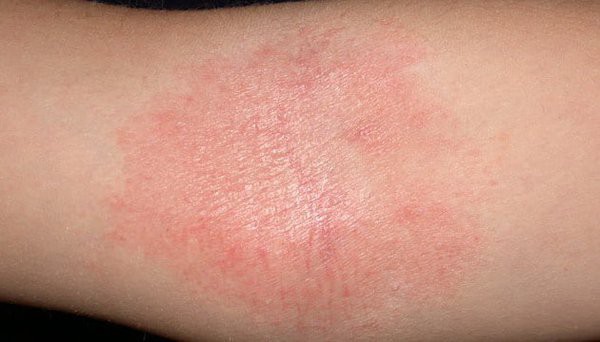 Bệnh chàm với triệu chứng đỏ, mẩn ngứa trên da có thể do 6 nguyên nhân này gây ra nhưng lại bị bạn vô tình bỏ qua - Ảnh 1.