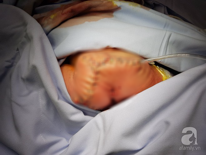  Thai phụ 19 tuổi ở Sài Gòn sinh bé gái mang khối u quái dị hình dạng như bào thai  - Ảnh 3.