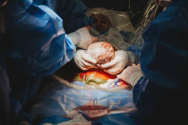 Nín thở xem khoảnh khắc nữ y tá tự tay nhấc con ra khỏi bụng mẹ trong ca sinh mổ của chính mình - Ảnh 2.
