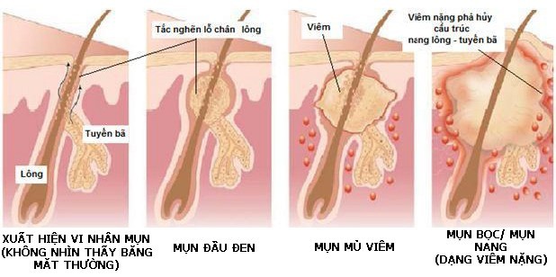 Ước gì da mặt được như da chân: vì sao mụn trứng cá không mọc ở chân bao giờ? - Ảnh 2.