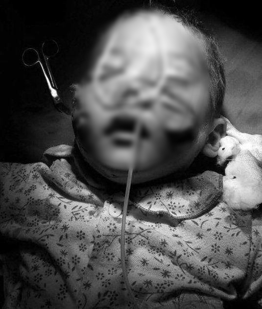 Lào Cai: Sang nhà chú chơi, cháu bé 29 tháng tuổi bị chó cắn dã man vào mặt - Ảnh 1.