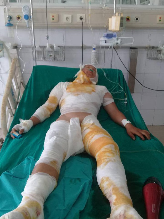 T&igrave;nh cảnh khốn kh&oacute; của người đ&agrave;n &ocirc;ng d&acirc;n tộc M&ocirc;ng bị điện cao thế giật bỏng to&agrave;n th&acirc;n - Ảnh 2.