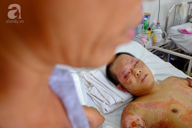 Thương cha kh&ocirc;ng đủ sức khỏe, cậu b&eacute; 16 tuổi hai lần l&oacute;c da cứu anh ruột bị lửa dầu thi&ecirc;u sống - Ảnh 5.