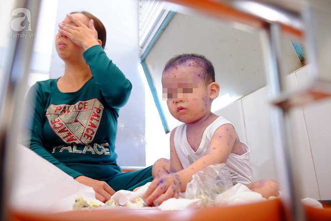 Mẹ không chích ngừa trước sinh, hàng loạt trẻ dưới 3 tháng tuổi mắc bệnh thủy đậu nhập viện tại TP.HCM - Ảnh 3. Mẹ không chích ngừa trước sinh, hàng loạt trẻ dưới 3 tháng tuổi mắc bệnh thủy đậu nhập viện tại TP.HCM - Ảnh 3.
