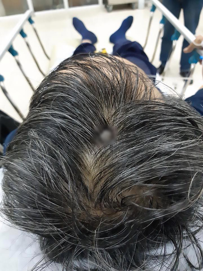 Báo Anh đưa tin bệnh nhân Việt không chịu đi khám dù đinh 8 cm xuyên vào đầu - Ảnh 1. Báo Anh đưa tin bệnh nhân Việt không chịu đi khám dù đinh 8 cm xuyên vào đầu - Ảnh 1.