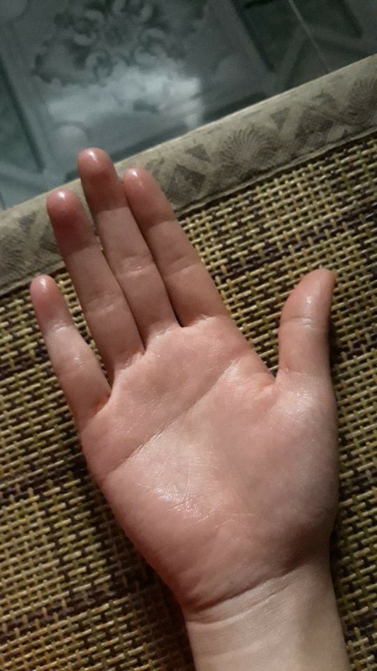Nỗi khổ của những thanh ni&ecirc;n c&oacute; b&agrave;n tay ướt nhẹp quanh năm - Ảnh 5.