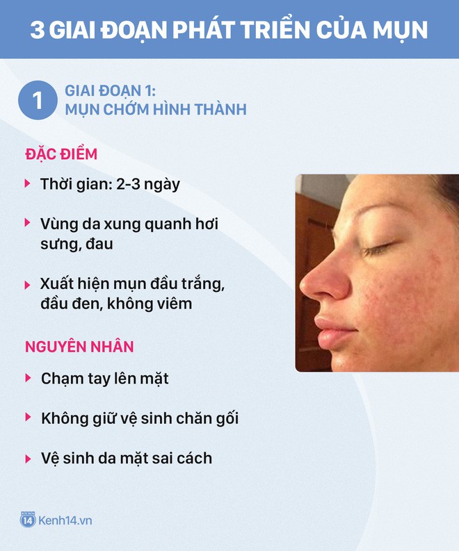 Muốn chữa mụn trứng cá hiệu quả cũng phải biết cách trị theo đúng giai đoạn - Ảnh 2.