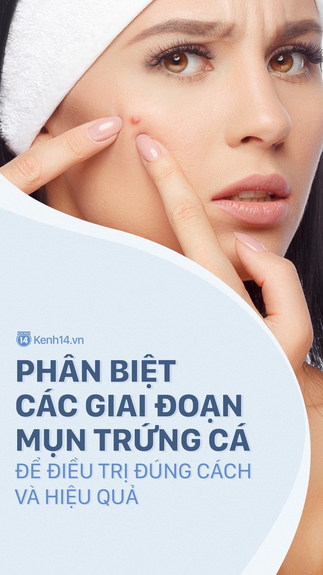 Muốn chữa mụn trứng cá hiệu quả cũng phải biết cách trị theo đúng giai đoạn - Ảnh 1.