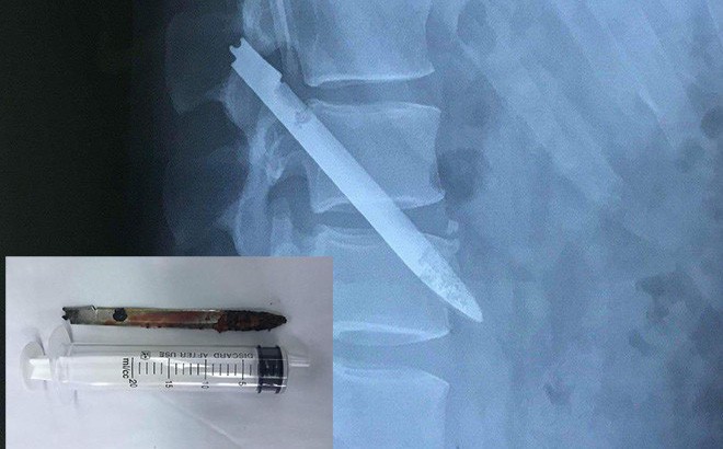 Lưỡi dao bị bỏ quên trong lưng chiến sỹ công an suốt 11 năm - Ảnh 1.