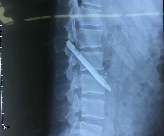 Lưỡi dao bị bỏ qu&ecirc;n trong lưng chiến sỹ c&ocirc;ng an suốt 11 năm - Ảnh 3.