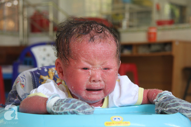 Người đầy vẩy ngứa như da trăn, bé gái 16 tháng tuổi bị bố mẹ bỏ rơi nên không có tiền chữa trị - Ảnh 1.