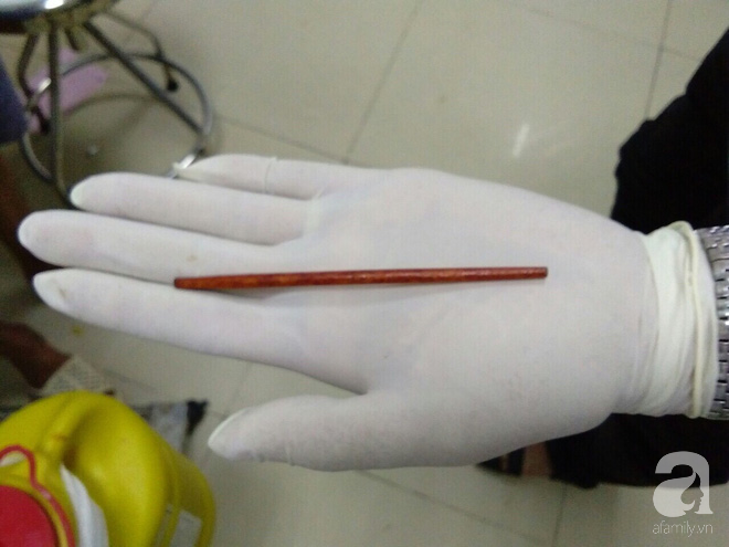 Say xỉn, người đàn ông ở Đồng Nai bị bạn nhậu ghim chiếc đũa 12 cm thẳng vào của quý - Ảnh 1.