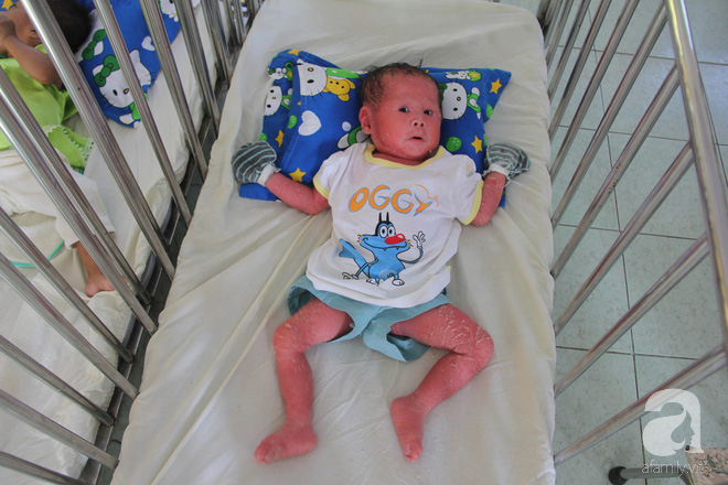 Người đầy vẩy ngứa như da trăn, bé gái 16 tháng tuổi bị bố mẹ bỏ rơi nên không có tiền chữa trị - Ảnh 16.