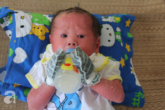 Người đầy vẩy ngứa như da trăn, bé gái 16 tháng tuổi bị bố mẹ bỏ rơi nên không có tiền chữa trị - Ảnh 8.