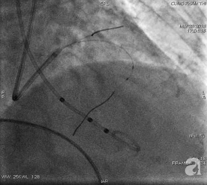 Nữ bệnh nhân ở Sài Gòn bị bệnh tim hiếm gặp được cứu sống nhờ... đốt cồn trong mạch máu - Ảnh 1.