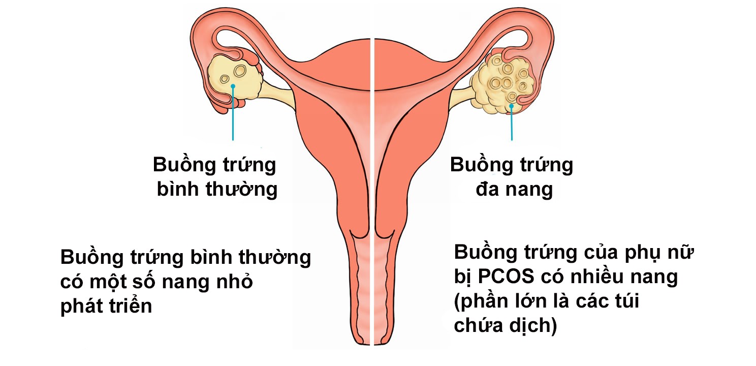 U nang buồng trứng - căn bệnh âm thầm diễn ra bên trong cơ thể ở lứa tuổi dậy thì - Ảnh 1. U nang buồng trứng - căn bệnh âm thầm diễn ra bên trong cơ thể ở lứa tuổi dậy thì - Ảnh 1.