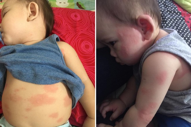 Cậu b&eacute; bị nổi ban đỏ, n&ocirc;n mửa v&agrave; ti&ecirc;u chảy nghi&ecirc;m trọng do uống sữa c&ocirc;ng thức giả - Ảnh 3.