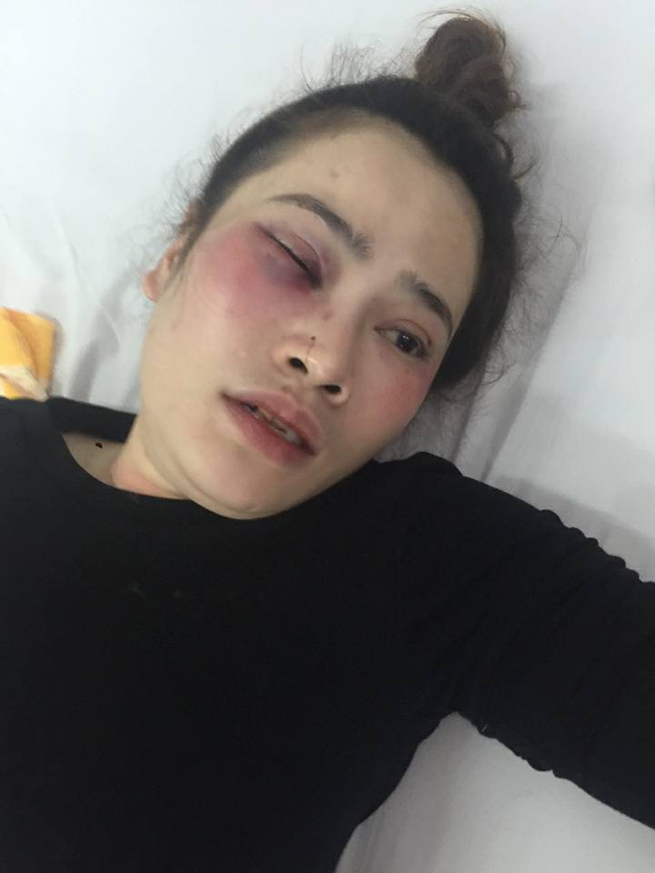 Đà Nẵng: Tranh nhau ăn trước đĩa bánh xèo, nam sinh viên đánh cô gái gãy răng cửa, phải nhập viện cấp cứu - Ảnh 1. Đà Nẵng: Tranh nhau ăn trước đĩa bánh xèo, nam sinh viên đánh cô gái gãy răng cửa, phải nhập viện cấp cứu - Ảnh 1.