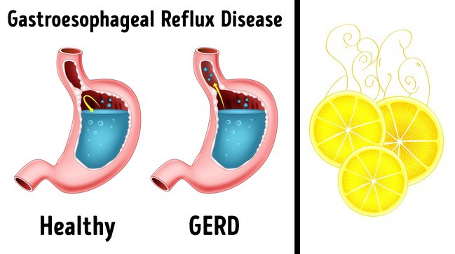 Hơi thở có mùi lạ cũng là một dấu hiệu sức khỏe mà bạn không nên xem thường - Ảnh 2. Hơi thở có mùi lạ cũng là một dấu hiệu sức khỏe mà bạn không nên xem thường - Ảnh 2.