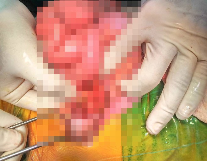 Phụ huynh quên tắt máy, bé trai 2 tuổi vặn ga xe máy đè thủng ruột bạn cùng lớp - Ảnh 2.