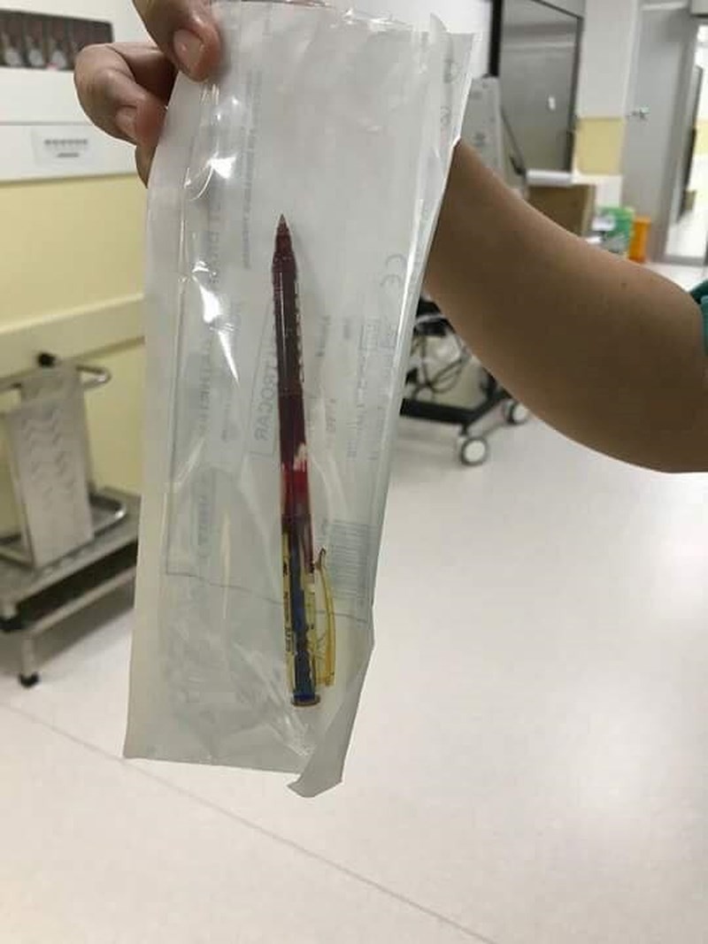 Bé gái 4 tuổi vấp té bị bút bi đâm thấu ngực - Ảnh 1. Bé gái 4 tuổi vấp té bị bút bi đâm thấu ngực - Ảnh 1.