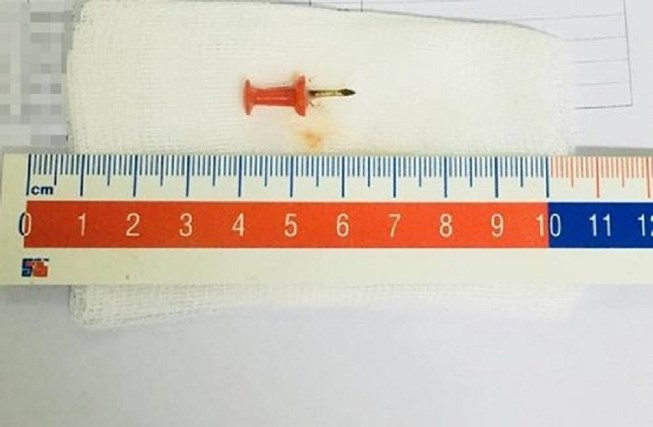 Nuốt phải đinh sắt 1,5cm vào bụng, bé 2 tuổi suýt chết - Ảnh 1.