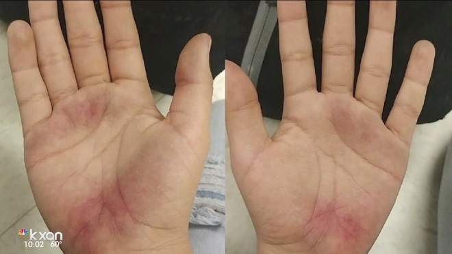 Mỹ: Con đi học về với đ&ocirc;i b&agrave;n tay trầy trụa, mẹ b&aacute;o nh&agrave; trường v&agrave; cảnh s&aacute;t v&agrave;o cuộc điều tra ngay lập tức - Ảnh 1.
