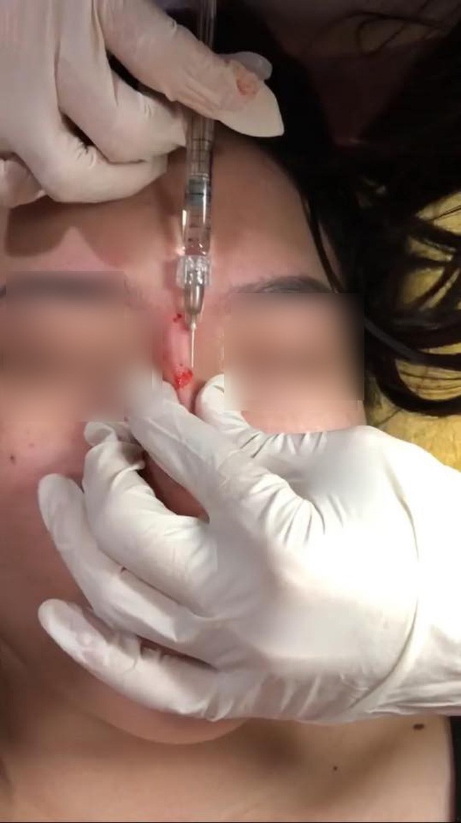 Clip tiêm Filler vào mũi sau đó bóp nặn thành dáng cao dài thẳng tắp đang được nhiều chị em chia sẻ vì... quá đáng sợ - Ảnh 2. Clip tiêm Filler vào mũi sau đó bóp nặn thành dáng cao dài thẳng tắp đang được nhiều chị em chia sẻ vì... quá đáng sợ - Ảnh 2.
