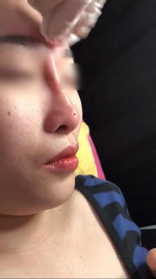 Clip tiêm Filler vào mũi sau đó bóp nặn thành dáng cao dài thẳng tắp đang được nhiều chị em chia sẻ vì... quá đáng sợ - Ảnh 4. Clip tiêm Filler vào mũi sau đó bóp nặn thành dáng cao dài thẳng tắp đang được nhiều chị em chia sẻ vì... quá đáng sợ - Ảnh 4.