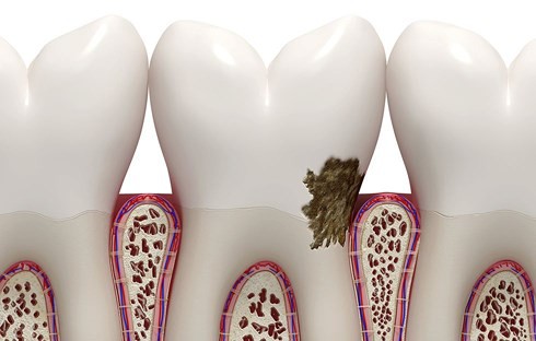 Dấu hiệu bệnh nướu răng không nên bỏ qua - Ảnh 5.