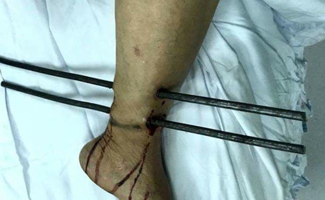 Người bán vé số bị 2 thanh sắt công trình đâm xuyên cẳng chân  - Ảnh 1.
