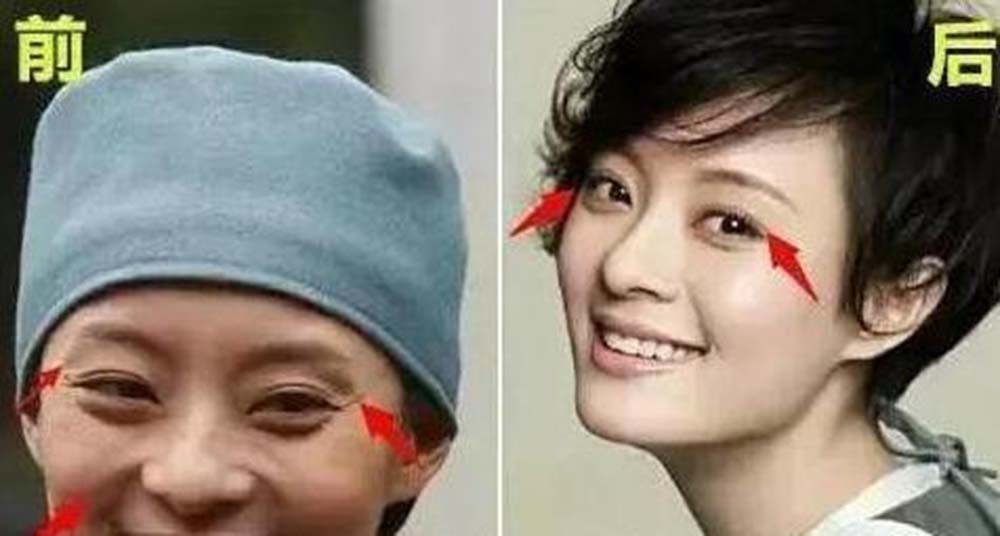 Nghịch lý showbiz: Người thừa nhận dao kéo ngày càng đẹp tự nhiên, kẻ chối bay chối biến lại lộ di chứng thẩm mỹ - Ảnh 12. Nghịch lý showbiz: Người thừa nhận dao kéo ngày càng đẹp tự nhiên, kẻ chối bay chối biến lại lộ di chứng thẩm mỹ - Ảnh 12.