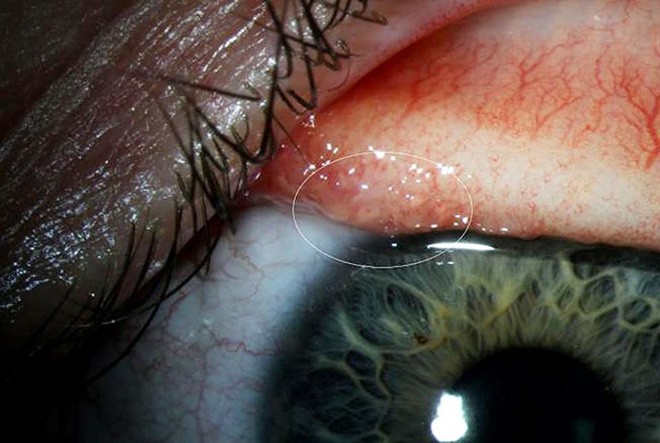 Sơ cứu khi bị dị vật rơi vào mắt, tránh nhiễm trùng mắt cũng như nguy cơ mù lòa - Ảnh 3.