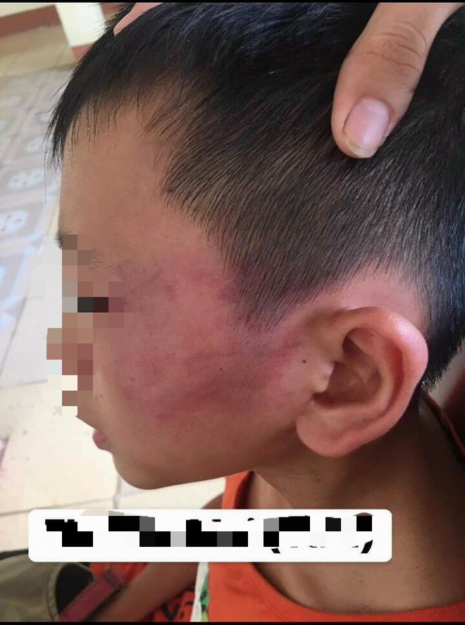 Vụ mẹ kế nghi bạo h&agrave;nh ch&aacute;u b&eacute; 12 tuổi đến nhập viện ở Nghệ An: C&ocirc;ng an v&agrave;o cuộc, đang lấy lời khai hai b&ecirc;n li&ecirc;n quan - Ảnh 1.