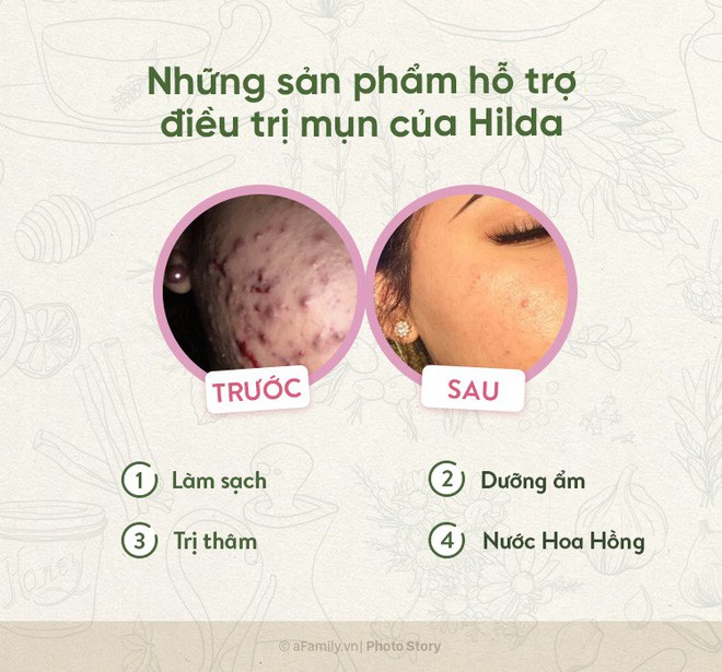 Chỉ với trà xanh và mật ong, cô nàng này đã chữa khỏi làn da bị mụn trứng cá viêm của mình  - Ảnh 10.