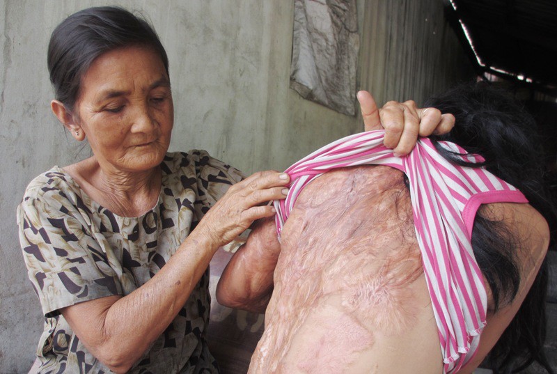 Nghẹn lòng ước mơ của bé gái bị tình địch của mẹ tạt a-xít mù hai mắt - Ảnh 3.