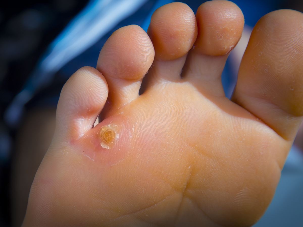 6 vấn đề sức khỏe biểu hiện ở bàn chân mà bạn tuyệt đối không nên bỏ qua - Ảnh 5. 6 vấn đề sức khỏe biểu hiện ở bàn chân mà bạn tuyệt đối không nên bỏ qua - Ảnh 5.