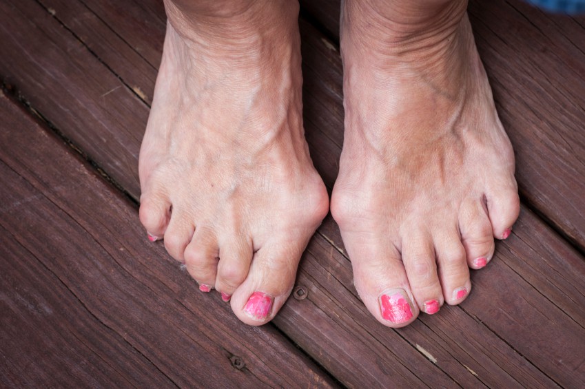 6 vấn đề sức khỏe biểu hiện ở bàn chân mà bạn tuyệt đối không nên bỏ qua - Ảnh 4. 6 vấn đề sức khỏe biểu hiện ở bàn chân mà bạn tuyệt đối không nên bỏ qua - Ảnh 4.