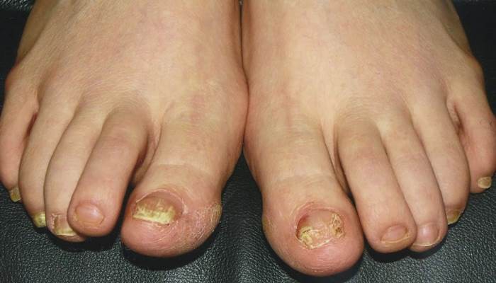 6 vấn đề sức khỏe biểu hiện ở bàn chân mà bạn tuyệt đối không nên bỏ qua - Ảnh 1. 6 vấn đề sức khỏe biểu hiện ở bàn chân mà bạn tuyệt đối không nên bỏ qua - Ảnh 1.