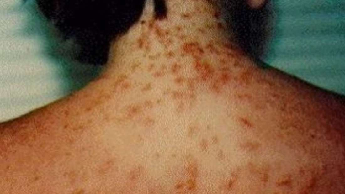 Nhiều bãi biển tại Mỹ đang gặp họa vì bị loại quái vật tí hon ăn thịt người này xâm chiếm - Ảnh 2.