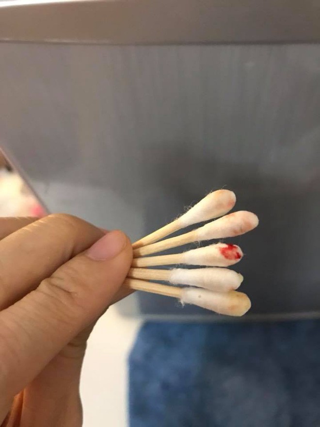 N&acirc;ng mũi bằng sụn nh&acirc;n tạo, c&ocirc; g&aacute;i xinh đẹp bị nhiễm tr&ugrave;ng mưng mủ gần nửa năm, chịu bao đau đớn để phục hồi nhan sắc - Ảnh 8.